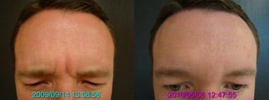 Wrinkles Between the Eyes: Is Botox Always the Best Solution? | Blogs