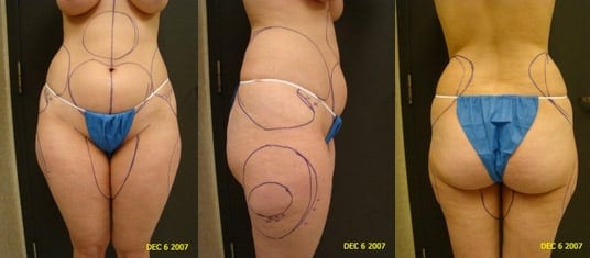 Upper and Lower Abdomen and Flank Liposuction, Inner and Outer Thigh  Liposuction with Fat Transfer to Buttocks - Terrell Clinic