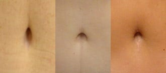 During a Tummy Tuck, What Happens to Your Belly Button? – Dr