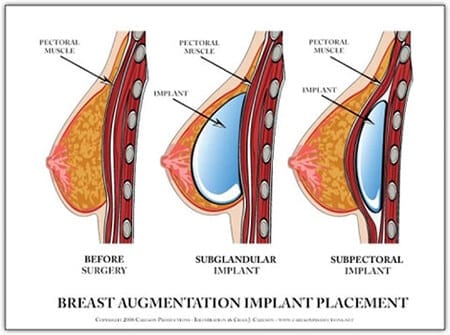 Breast Implant Placement: Over vs Under the Chest Muscle