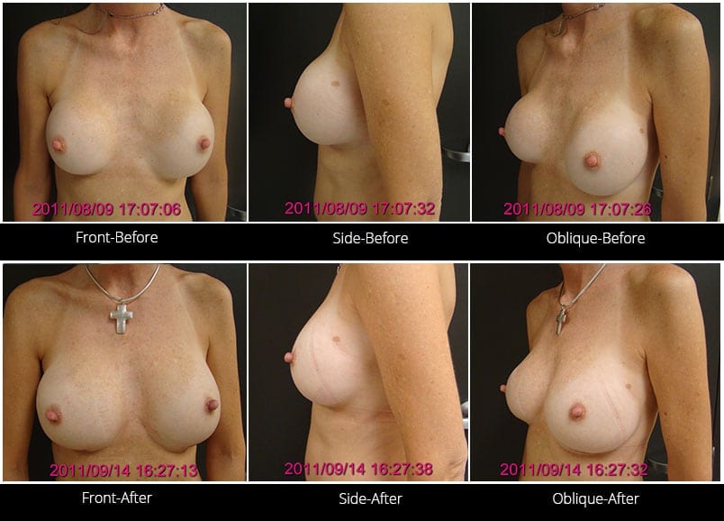 Breast Implant Revision Before & After 5 Full