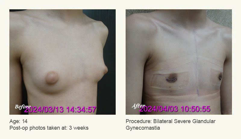 Gynecomastia Male Breast Reduction Plano TX Ronald Friedman M.D