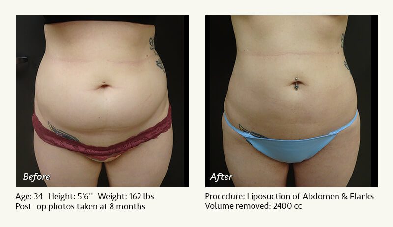 Laser Liposuction Touch Ups