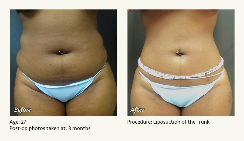 Liposuction Austin Tx