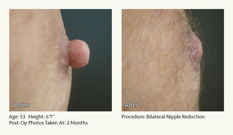 Male Nipple Reduction in Plano & Dallas, TX