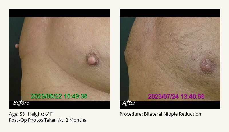 Areola Reduction Surgery Procedure Cost and Information