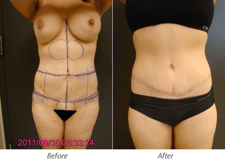 Belt Lipectomy with Bilateral Excision of Gynecomastia and