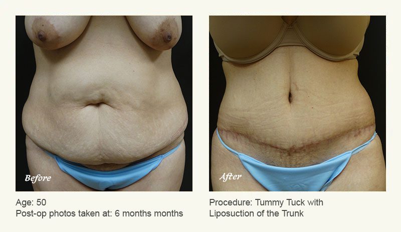 Tummy Tuck Austin