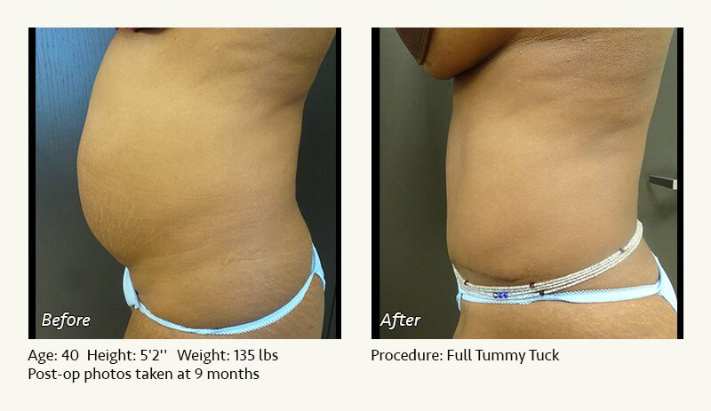 Fever after tummy tuck