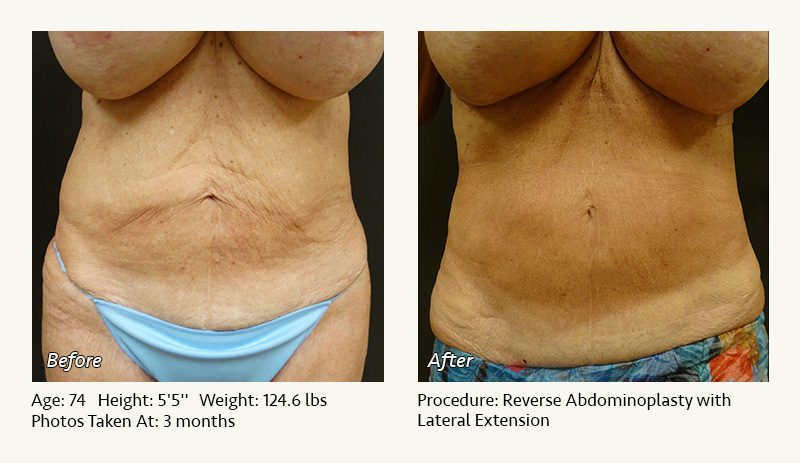 Supplies for Body Contour Surgery: Abdominoplasty, Body Lift, Liposuction