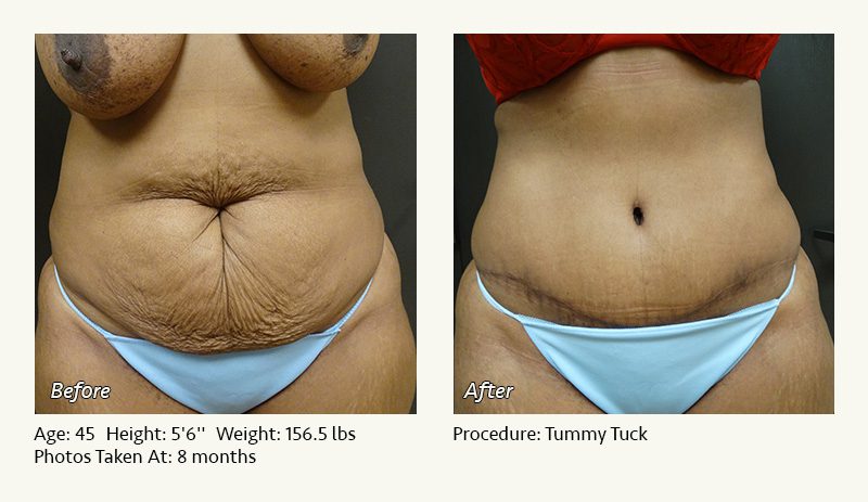 One day after tummy tuck surgery with compression garnent and