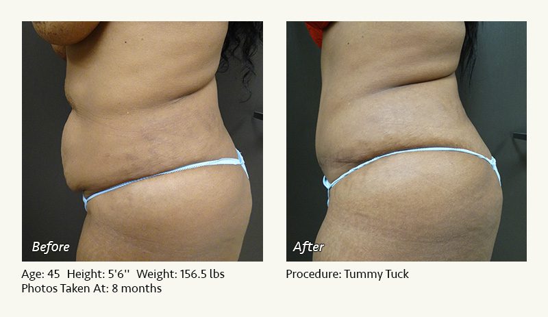 Fleur-de-lis abdominoplasty and excision of excess skin of the lateral  thighs and buttocks