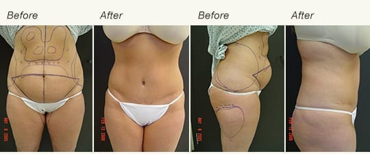 Vertical Scars in Tummy Tuck - Articles by Ronald M. Friedman, M.D.
