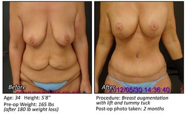 Breast Lift Before and After