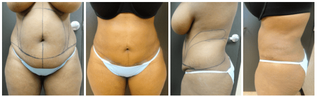 Tummy tuck results 🔥 @drzhzps performed a full tummy tuck with