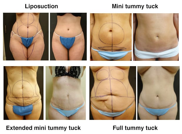 Mini Tummy Tuck: Cost, Procedure, and More