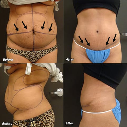 Liposuction vs. Tummy Tuck - Frisco, TX - Plano, TX - North Texas