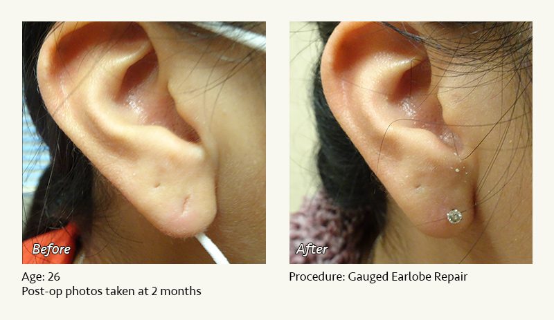 Earlobe Surgery In Plano Dallas Tx Ronald Friedman M D