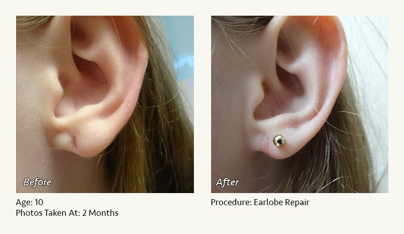 Is Your Piercing Infected  Solace Jewellery Ltd