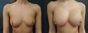 Breast Procedures Actual Patient Results