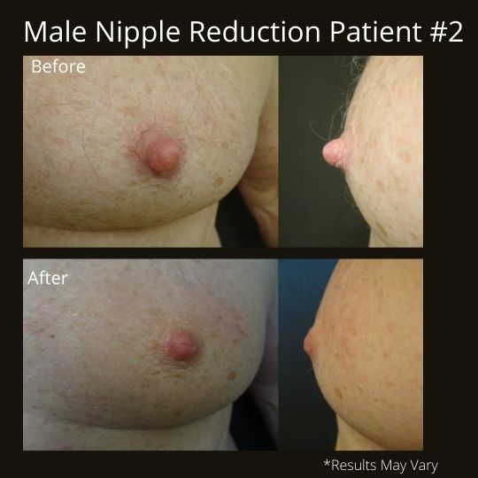 Polaris - Nipple and Areola Reduction